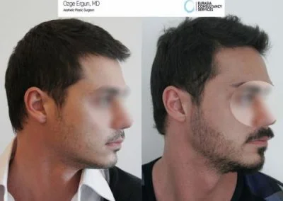 השתלת זקן בטורקיה תמונה 3