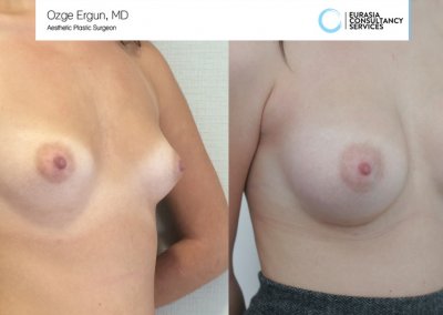 Breast_Implant_17