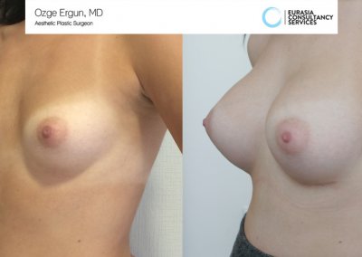 Breast_Implant_18