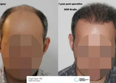 השתלת שיער 3320 שתלים לפני ואחרי