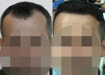 השתלת שיער לאחר שנתיים מהניתוח