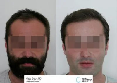 השתלת זקן ושיער לגבר בן 35 בטורקיה