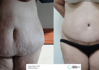 לפני ואחרי ניתוח מתיחת בטן אישה בת 49
