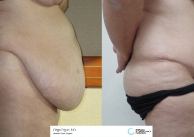 לפני ואחרי ניתוח מתיחת בטן אישה בת 49 בטורקיה
