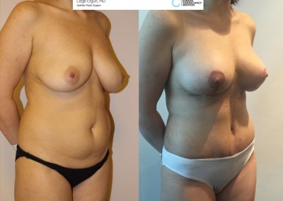 לפני ואחרי ניתוח מתיחת בטן אישה בת 40
