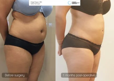 שאיבת שומן לפני ואחרי POST OP לאחר חודש