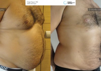 שאיבת שומן לפני ואחרי גבר בן 40 לאחר חודשיים