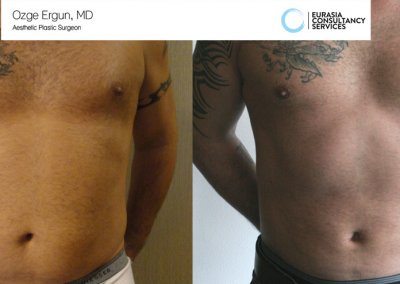 שאיבת שומן לפני ואחרי גבר בן 35 תמונה נוספת