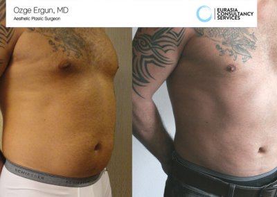 שאיבת שומן לפני ואחרי גבר בן 35