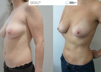 שאיבת שומן לפני ואחרי אישה בת 38 תמונה נוספת