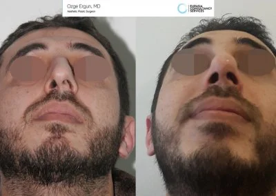 לפני ואחרי ניתוח אף גבר בן 31 מלמטה