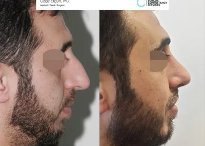 לפני ואחרי ניתוח אף גבר בן 31 פרופיל צד