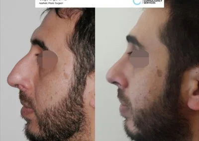 לפני ואחרי ניתוח אף גבר בן 31 פרופיל צד ב