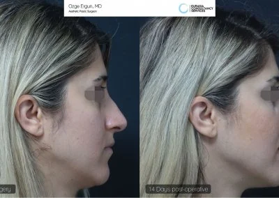 ניתוח אף לפני ואחרי בטורקיה איסטנבול אישה בת 45