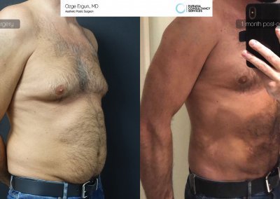 לפני ואחרי שאיבת שומן חודש לאחר הניתוח