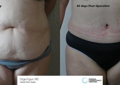 לפני ואחרי ניתוח מתיחת בטן אישה בת 41