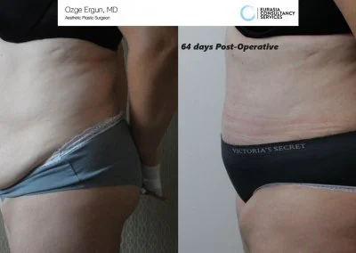 לפני ואחרי ניתוח מתיחת בטן אישה בת 41 פרופיל צד