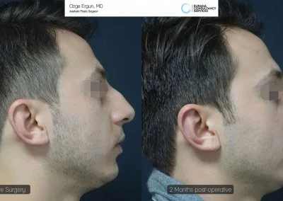 ניתוח אף לפני ואחרי גבר בן 28 תמונה מהצד