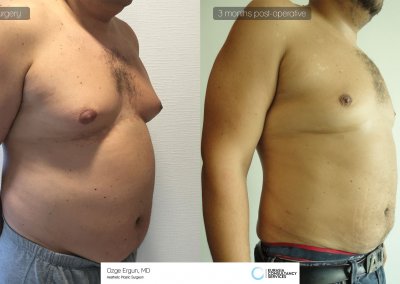 לפני ואחרי ניתוח שאיבת שומן בטורקיה איסטנבול בן 45