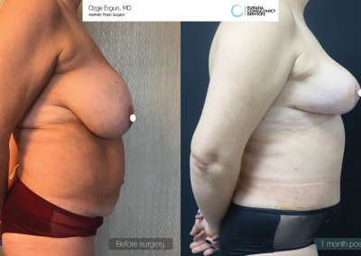 לפני ואחרי ניתוח מתיחת בטן לאחר חודש