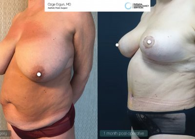 לפני ואחרי ניתוח מתיחת בטן אישה בטורקיה