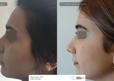 לפני ואחרי ניתוח אישה בת 27