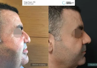 ניתוח אף לפני ואחרי גבר בן 48