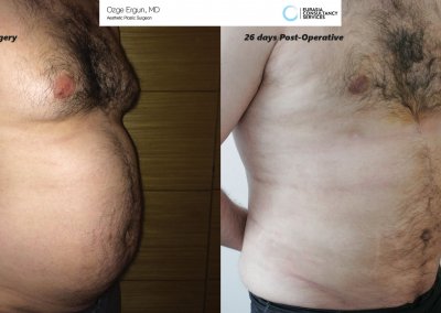 גינקומסטיה לגבר לפני ואחרי 26 לאחר הניתוח