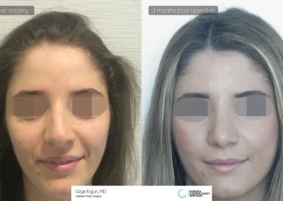 ניתוח אף לפני ואחרי אישה 3 חודשים