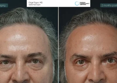 לפני ואחרי ניתוח הרמת עפעפיים לאחר חודשיים