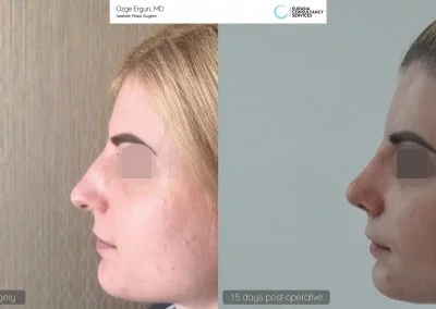 לפני ואחרי 15 יום לאחר הניתוח