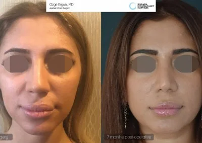 ניתוח אף לפני ואחרי אישה בת 25 בטורקיה