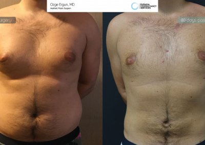 גינקומסטיה לגבר לפני ואחרי 80 יום מהניתוח
