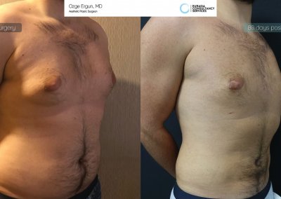 שאיבת שומן לפני ואחרי לאחר 80 יום תמונה נוספת 1
