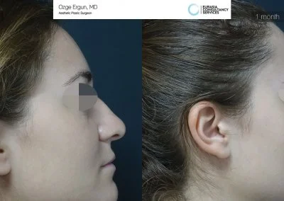 לפני ואחרי ניתוח אף בטורקיה 30 יום