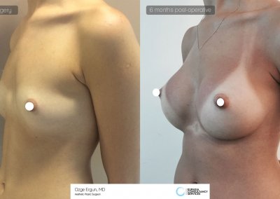 הגדלת חזה לפני ואחרי 6 חודשים מיום הניתוח