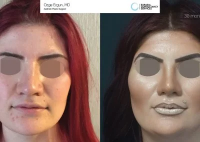 לפני ואחרי ניתוח אף בטורקיה 30 חודש תמונת פרופיל