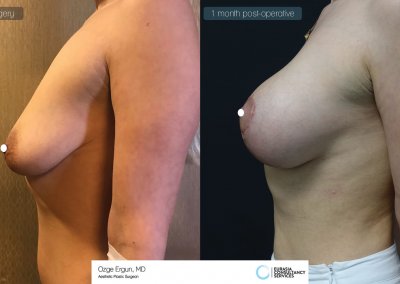 הגדלה + הרמת חזה לפני ואחרי חודש מיום הניתוח