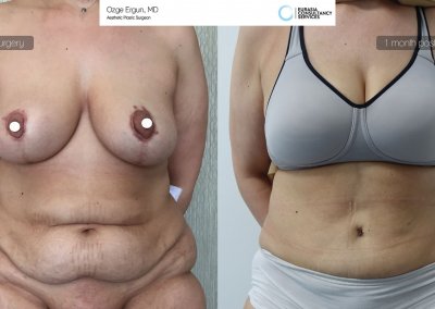 לפני ואחרי ניתוח מתיחת בטן אישה בת 45