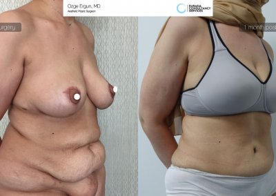 לפני ואחרי ניתוח מתיחת בטן אישה בת 45 בטורקיה