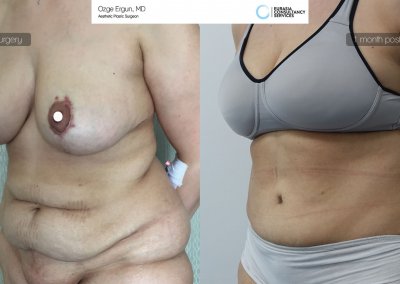 לפני ואחרי ניתוח מתיחת בטן לאחר חודש מהניתוח