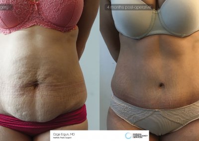 לפני ואחרי ניתוח מתיחת בטן אישה בת 45