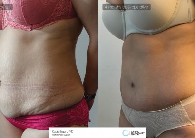לפני ואחרי ניתוח מתיחת בטן אישה בת 45 באיסטנבול