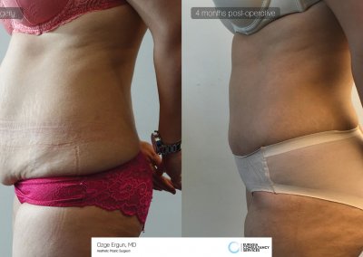 לפני ואחרי ניתוח מתיחת בטן אישה פרופיל צד
