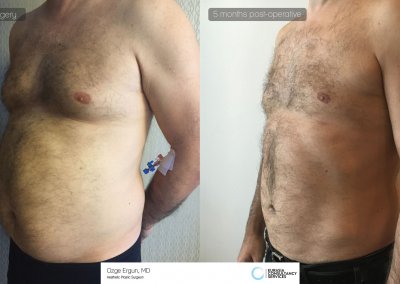 שאיבת שומן לפני ואחרי לאחר 5 חודשים תמונה נוספת