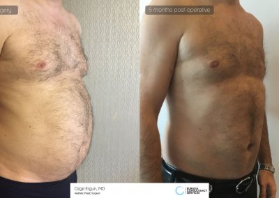 שאיבת שומן לפני ואחרי לאחר 5 חודשים