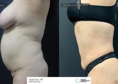 שאיבת שומן לפני ואחרי לאחר 36 ימים תמונה נוספת 1
