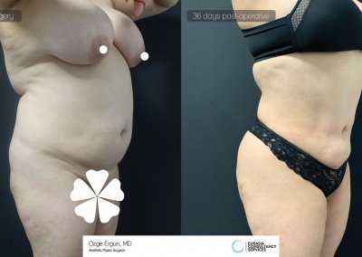 שאיבת שומן לפני ואחרי לאחר 36 ימים תמונה נוספת