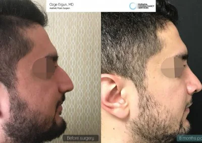 לפני ואחרי ניתוח 8 חודשים לאחר מכן גבר בן 28
