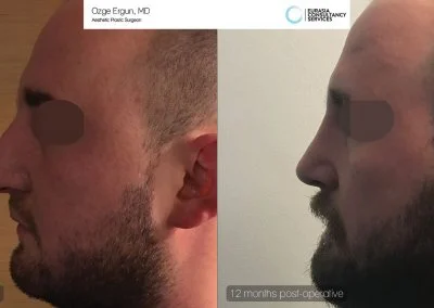 לפני ואחרי ניתוח אף תוצאה סופית לאחר שנה